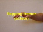 Flaping tremor